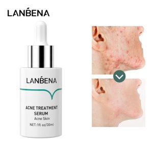 سرم ضدجوش و ضد آکنه برند لانبنا حجم 30 میلی لیتر Lanbena